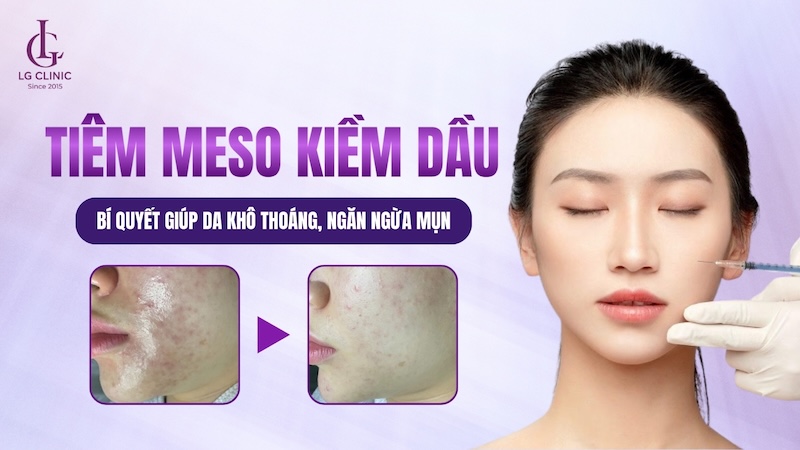 tiêm meso kiềm dầu