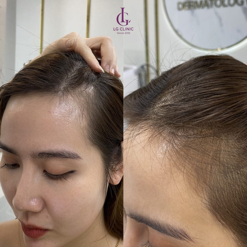 kết quả điều trị tiêm meso rụng tóc