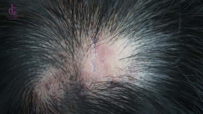 Rụng tóc do sẹo