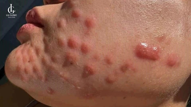 biến chứng tiêm meso