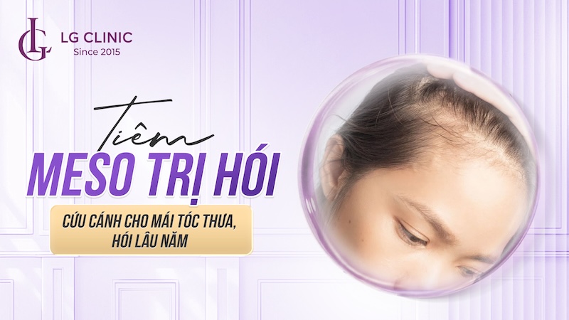 tiêm meso trị hói tóc