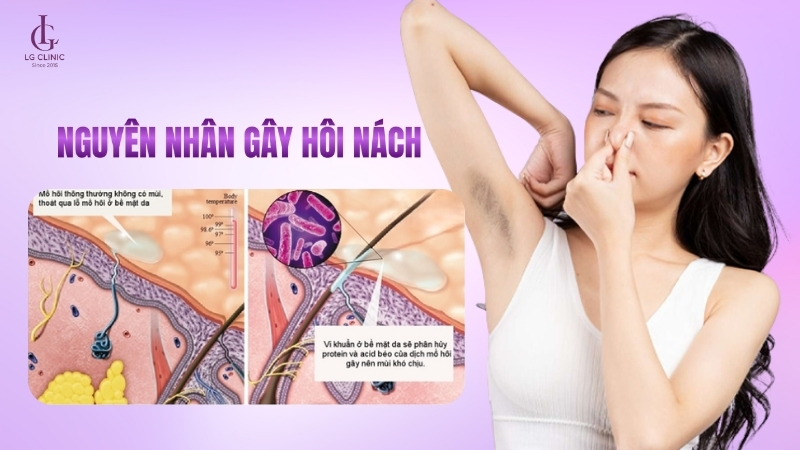 nguyên nhân gây hôi nách