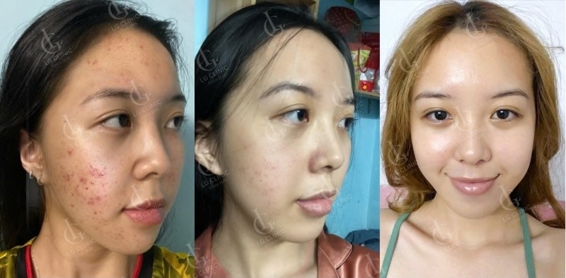 kết quả thực tế sau khi sử dụng meso trị mụn 1