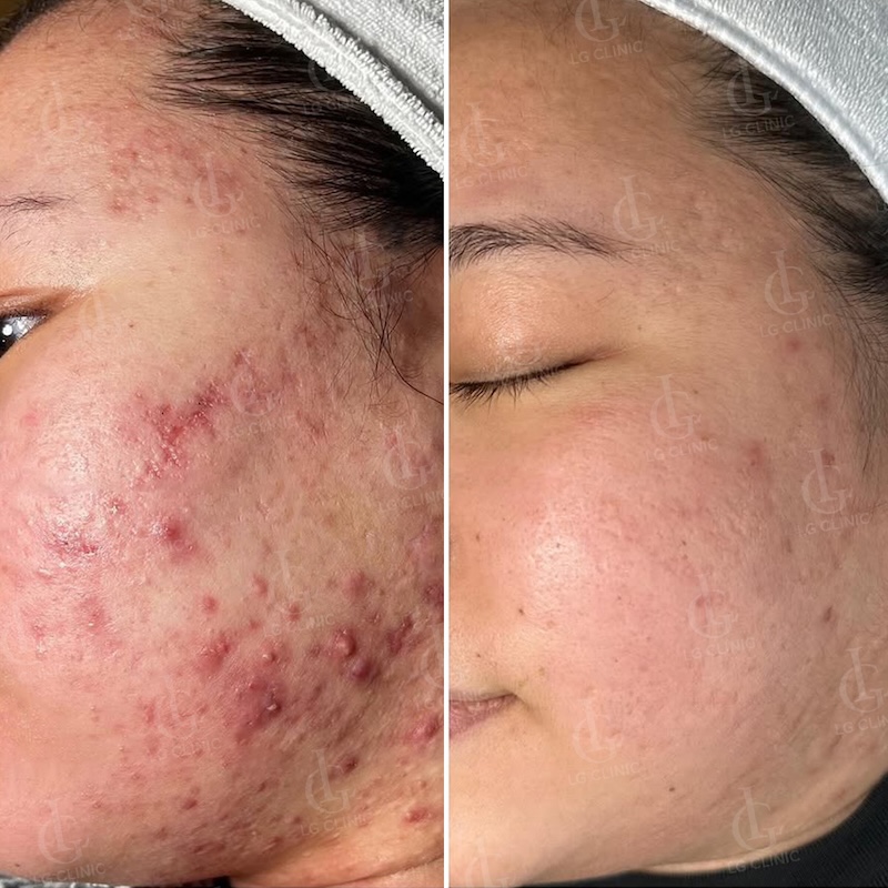 kết quả thực tế sau khi sử dụng meso trị mụn 2