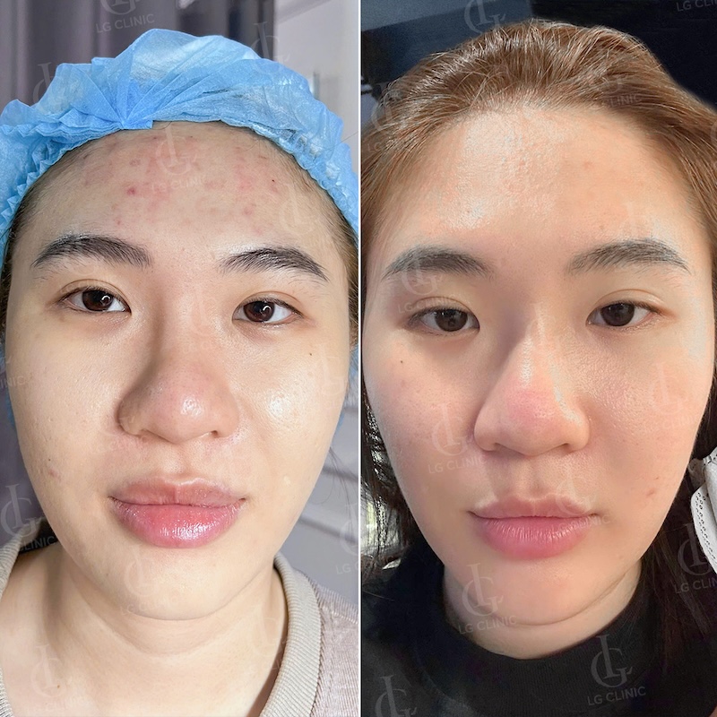 kết quả thực tế sau khi sử dụng meso trị mụn 3