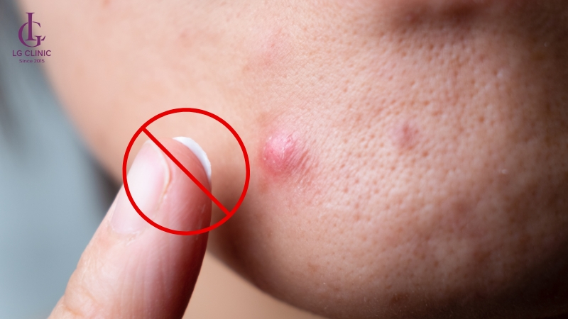 không bôi kem trị mụn