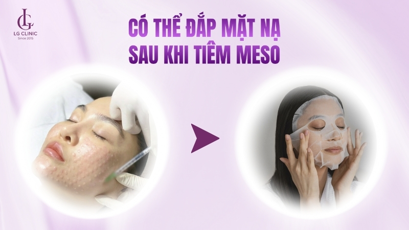đắp mặt nạ sau khi tiêm meso