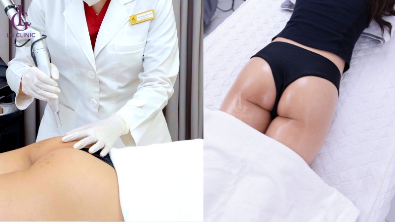 trị thâm mông bằng laser