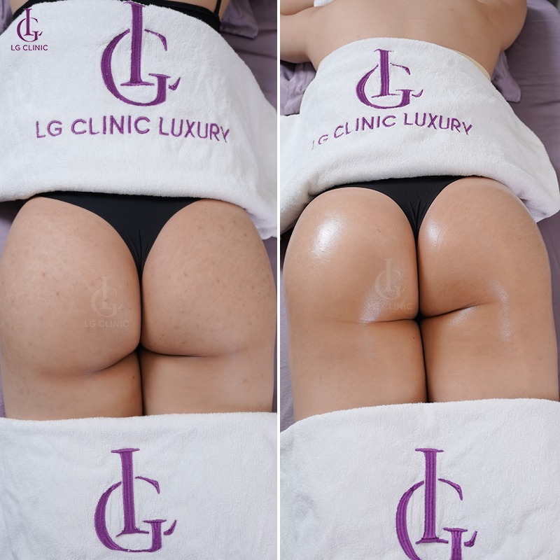 trị thâm mông bằng laser