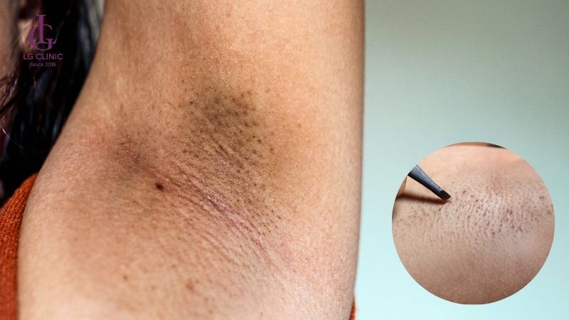 Cách trị thâm và hôi nách - hình ảnh trị thâm nách