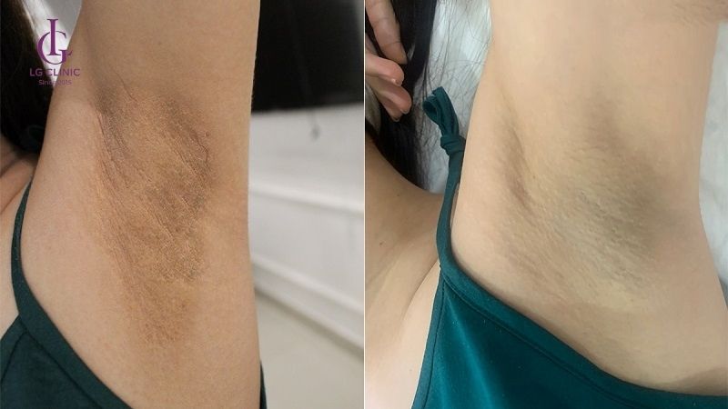hình ảnh khách hàng sau khi trị thâm và hôi nách