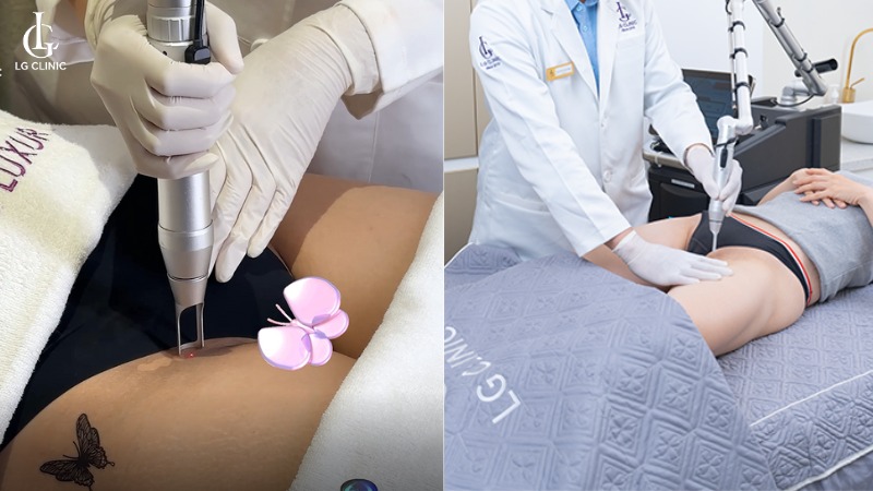 trị thâm vùng kín, trị thâm bẹn háng