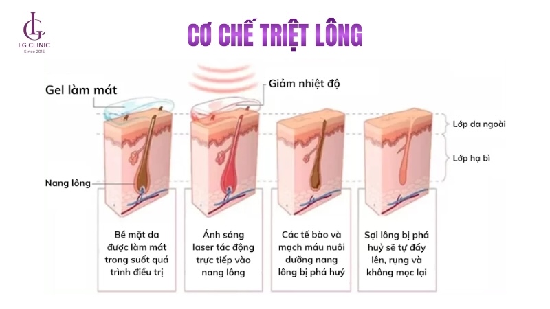 triệt lông chỉ tác động đến nang lông