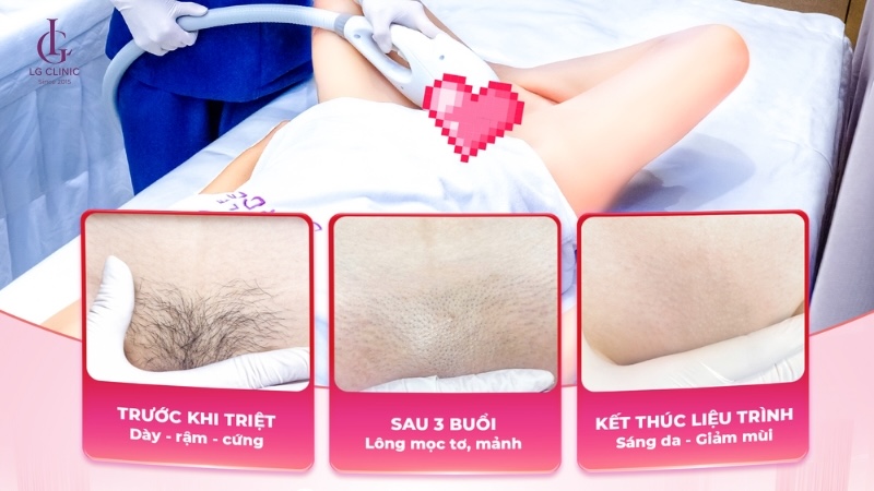 Triệt lông không gây ảnh hưởng