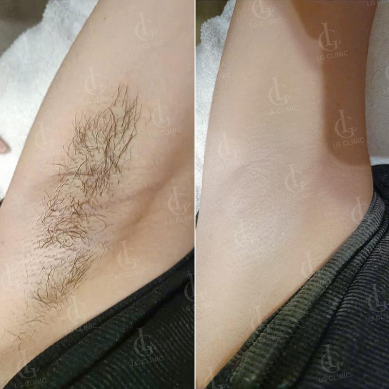 triệt lông nách tại LG Clinic