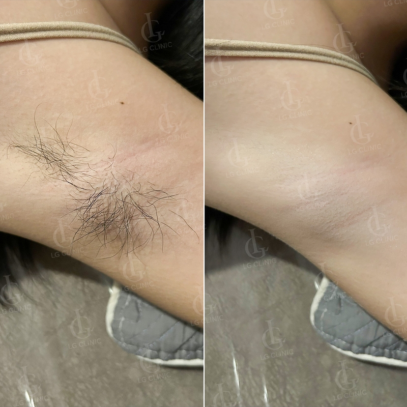 triệt lông nách tại LG Clinic