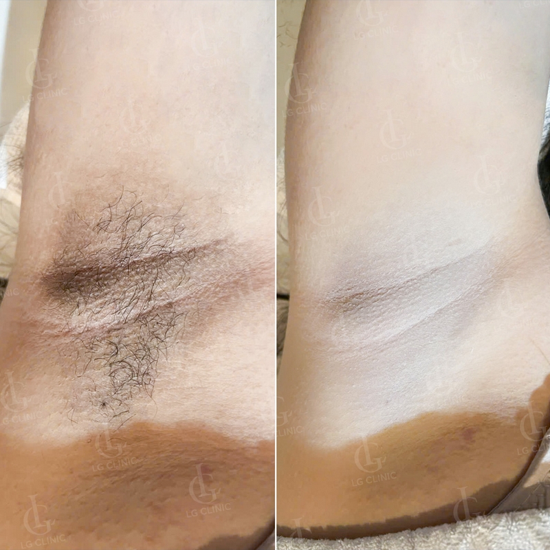 triệt lông nách tại LG Clinic