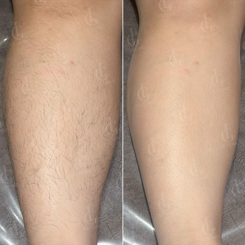 triệt lông chân tại LG Clinic