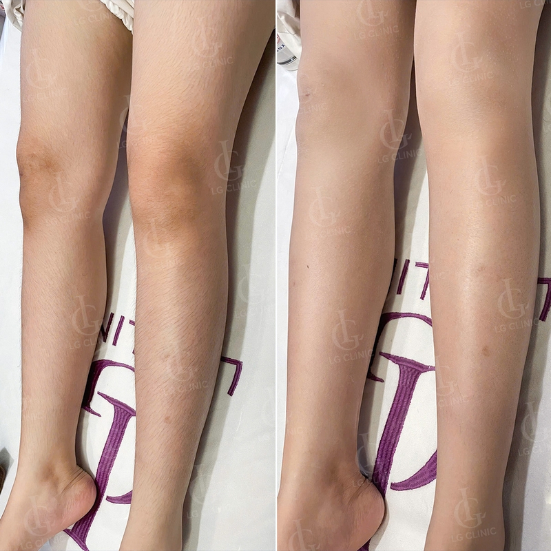triệt lông chân tại LG Clinic