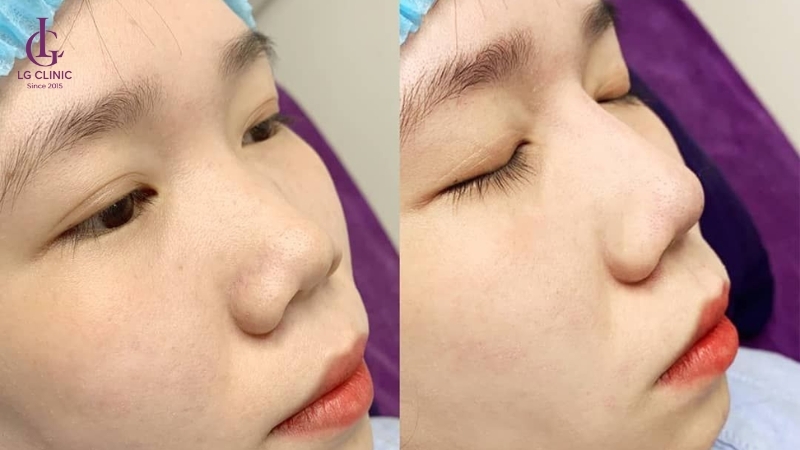 Tiêm filler nâng sống mũi
