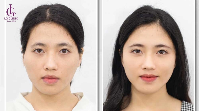 Tiêm filler thái dương