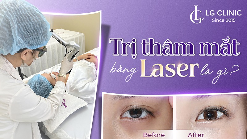 Trị thâm mắt bằng Laser là gì