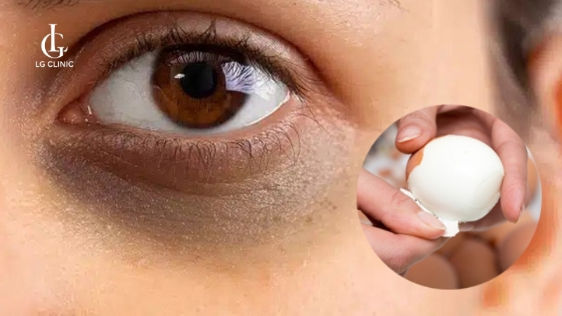 cách lăn trứng gà trị thâm mắt