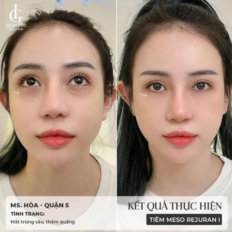 cách lăn trứng gà trị thâm mắt - tiêm trị thâm mắt