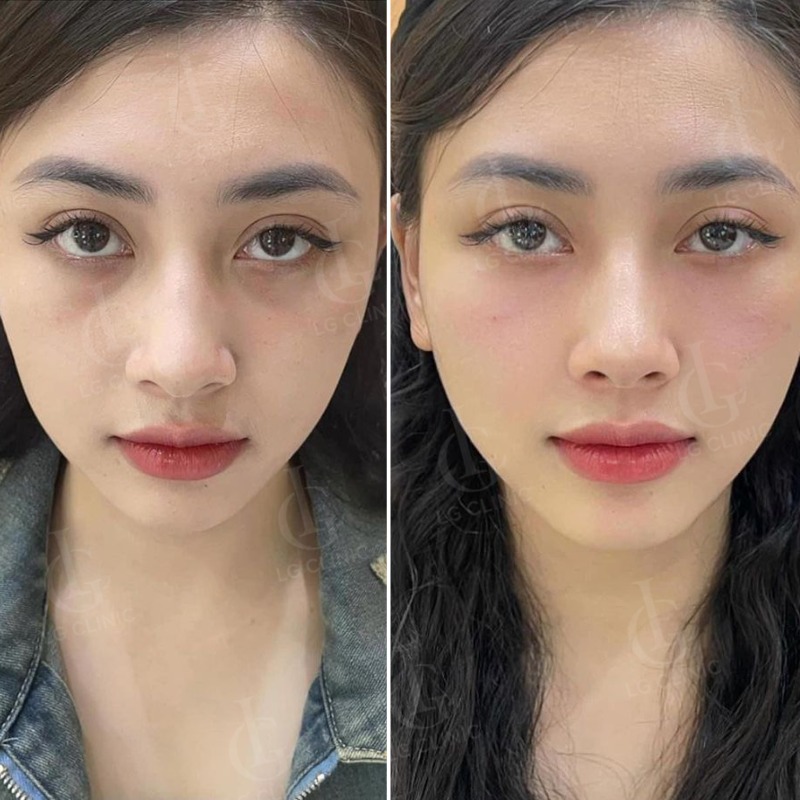 cách lăn trứng gà trị thâm mắt - tiêm trị thâm mắt