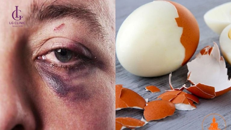 cách lăn trứng gà trị thâm mắt 