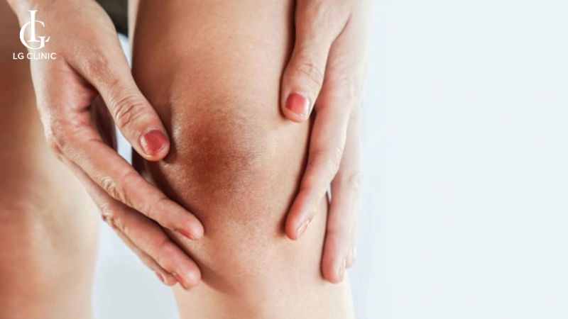 cách trị thâm đầu gối bằng nha đam