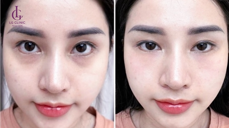 điều trị thâm quầng mắt ở đâu