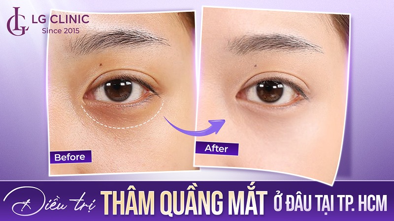 Điều trị thâm quầng mắt ở đâu tại TPHCM