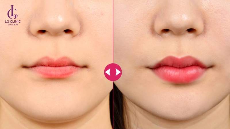 hình ảnh tiêm filler môi