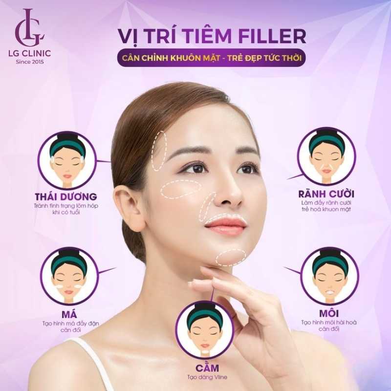 vị trí tiêm filler