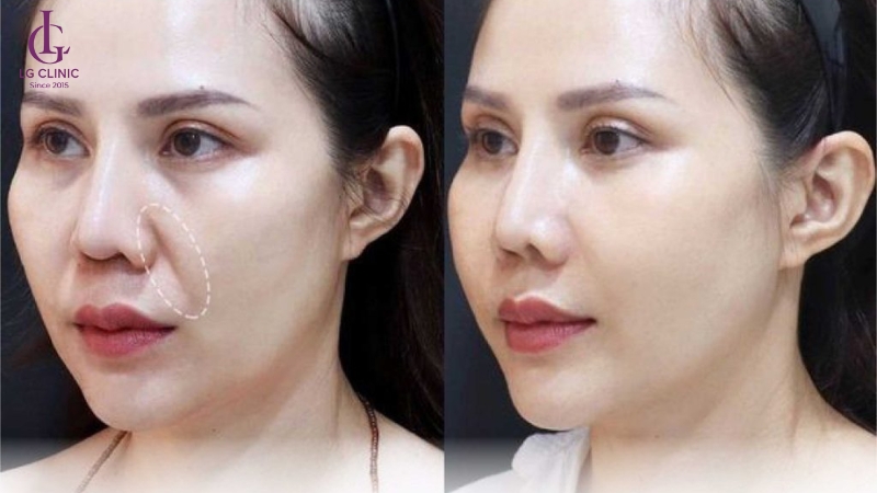 hình ảnh tiêm filler rãnh cười