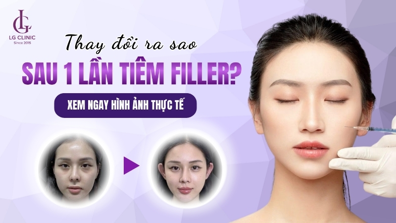 hình ảnh tiêm filler trước sau