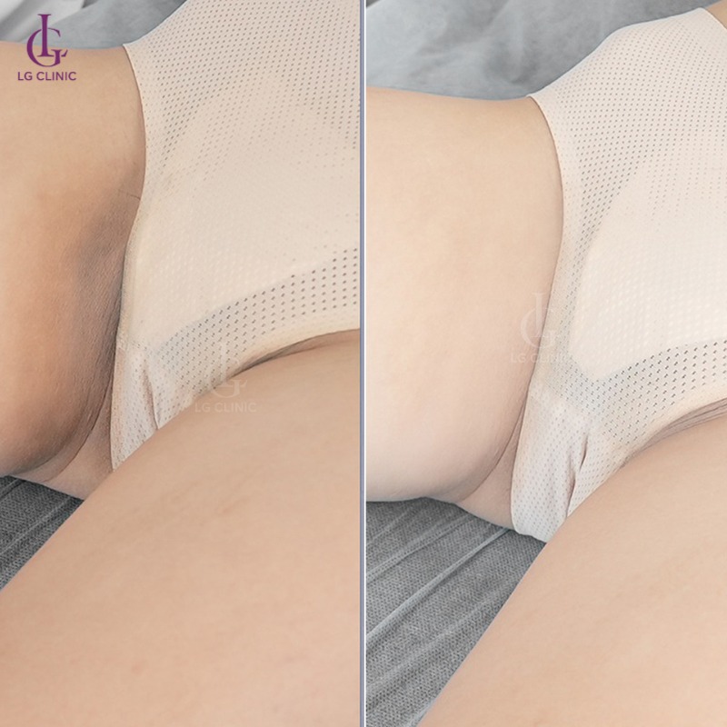 spa trị thâm háng - kem trị thâm háng