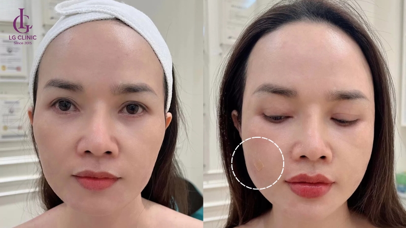 sau khi tiêm filler sẽ hơi sưng