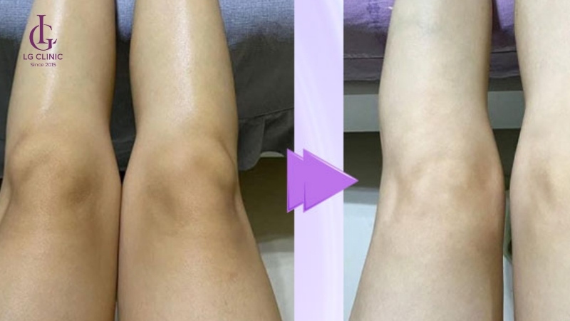 spa trị thâm đầu gối - thẩm mỹ viện trị thâm đầu gối