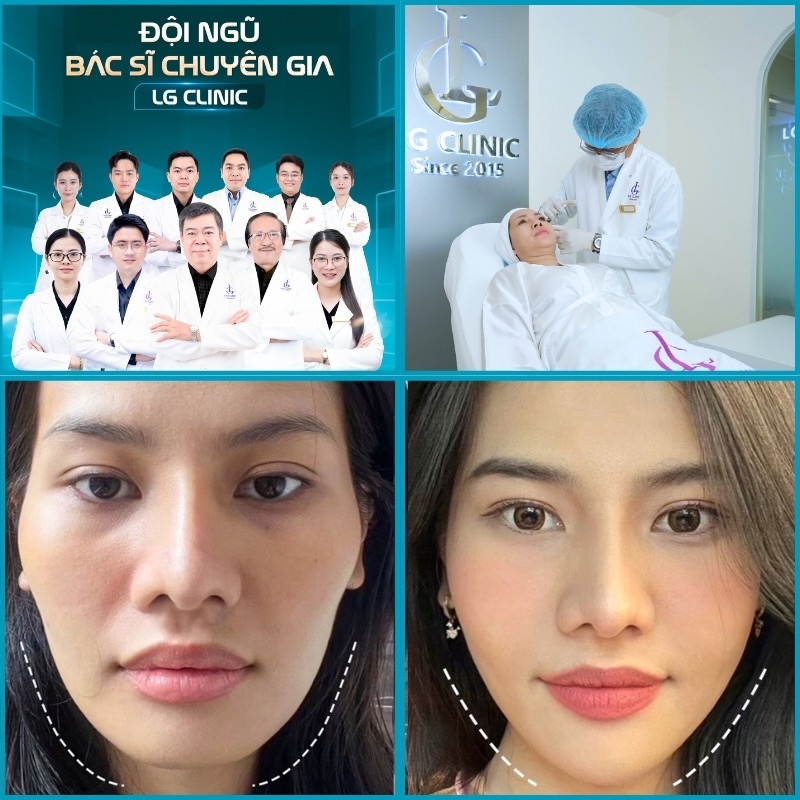 tiêm filler tại lg clinic
