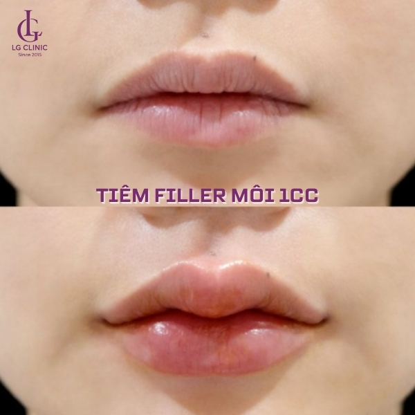 tiêm filler môi 1cc
