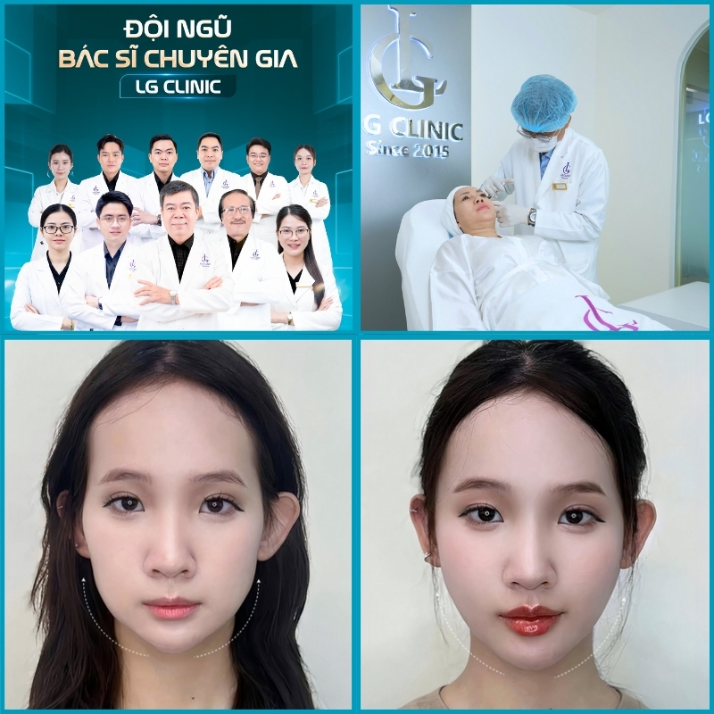 tiêm filler uy tín