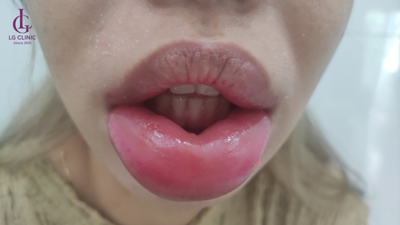 tiêm filler môi bị biến dạng