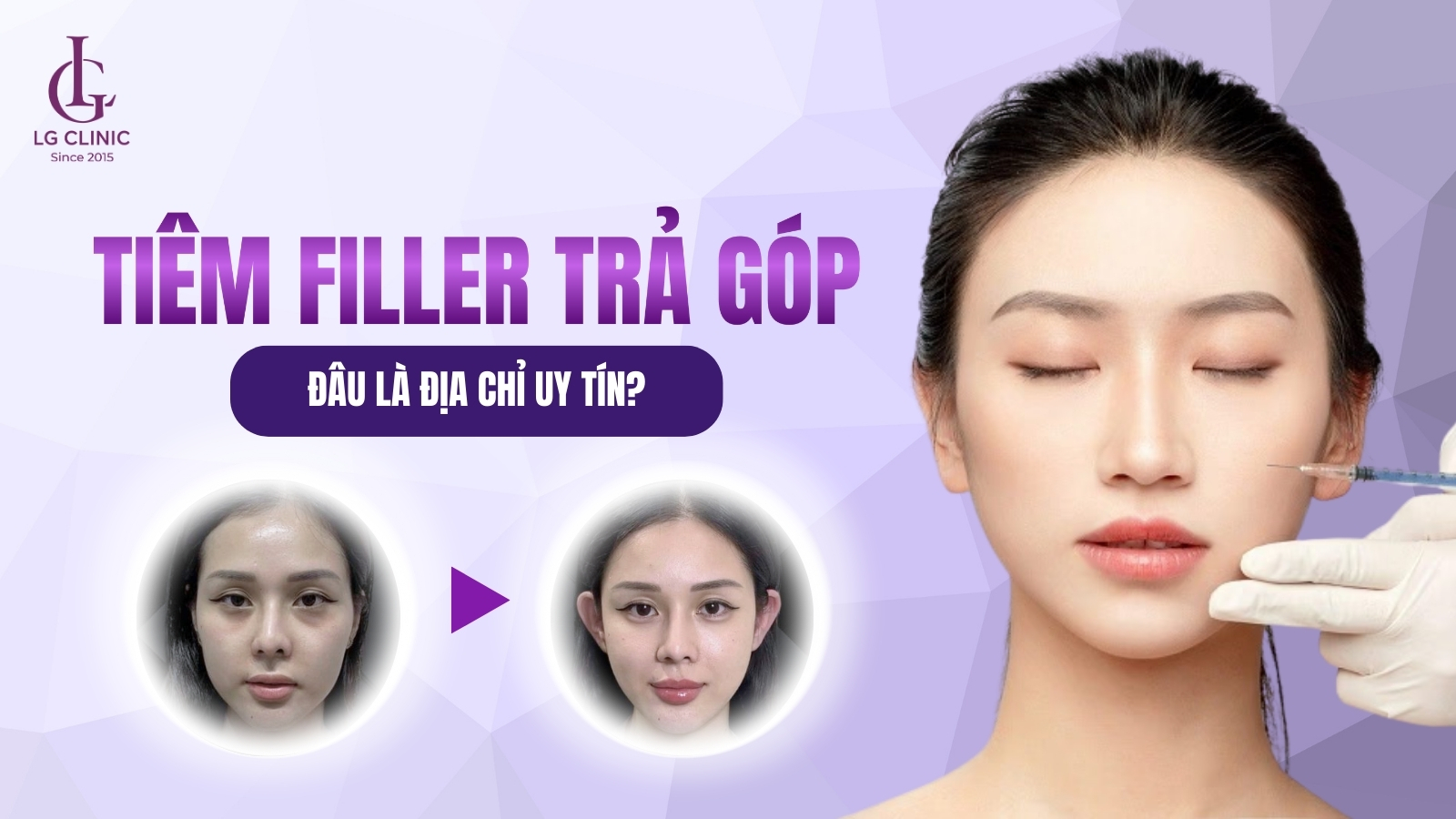 tiêm filler trả góp