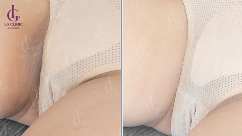 trị thâm bẹn bằng laser