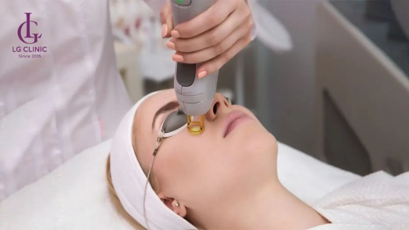 trị thâm mắt bằng laser