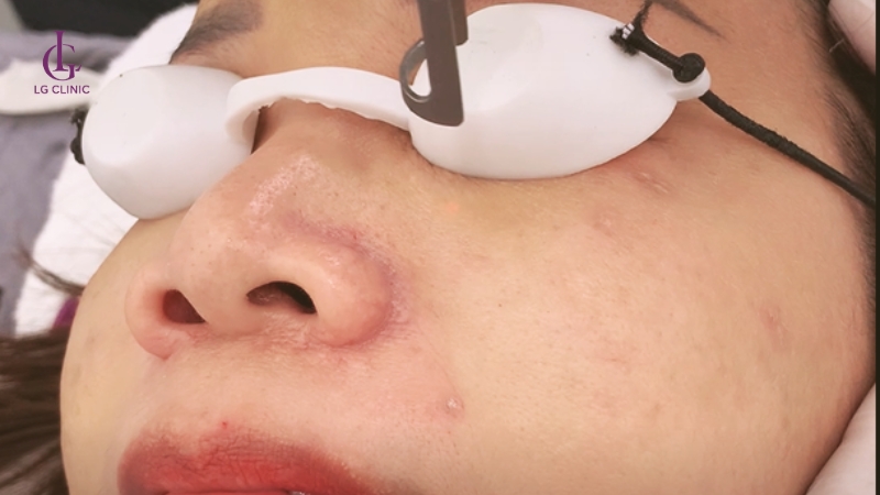 trị thâm mắt bằng laser - trị thâm quầng mắt bằng laser