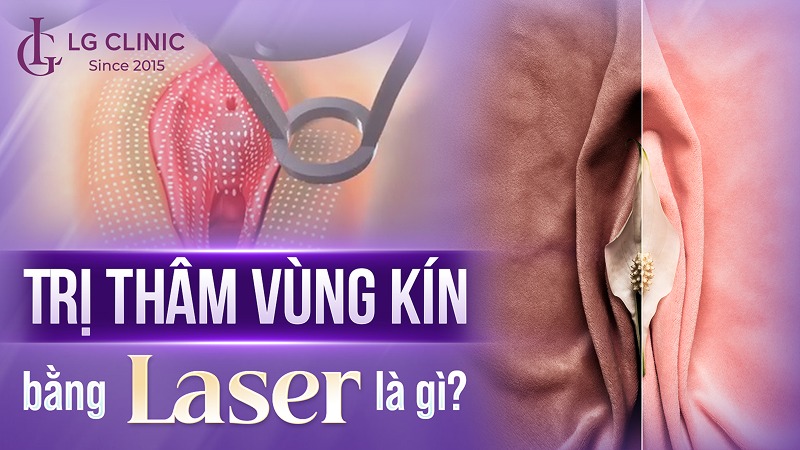 Trị thâm vùng kín bằng Laser là gì