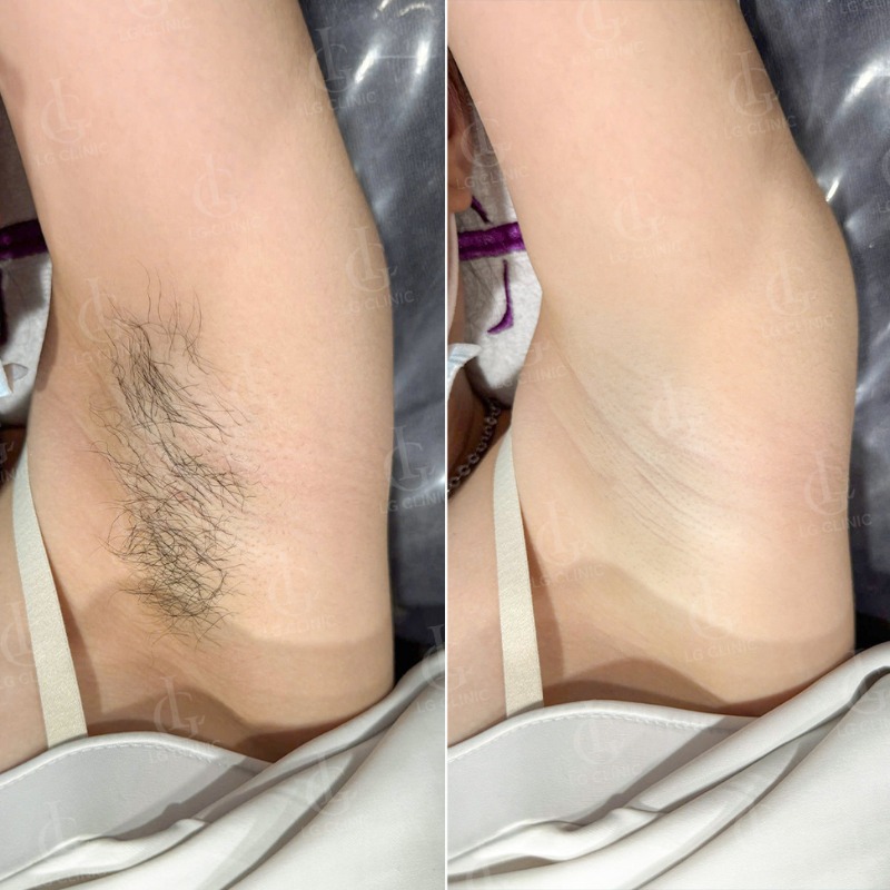 triệt lông nách bằng tia laser